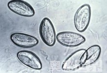 盘点最常见的10大人体寄生虫